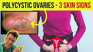Doctor explains 3 SKIN SIGNS ASSOCIATED WITH  POLYCYSTIC OVARIAN SYNDROME (PCOS)