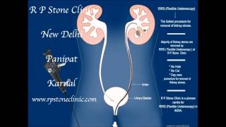 Dr Seymur Mehtiyev - Animation of Kidney stone treatment by RIRS- Flexible Ureteroscopy (2015)