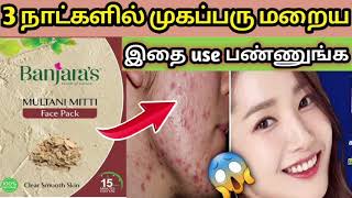 😱மூன்று நாட்களில் முகப்பரு மறைய💖🙈இதை Try பண்ணுங்க👌||How to Remove pimples on Face||💥🌅Multani mitti|👍