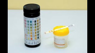 Dipstick Urinalysis Analysis