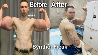 Russian Synthol Freak Boy  Oil Remove Surgery Ruki Bazuki Sergey