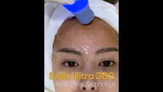 Noi Aswari Hamka Exilis Ultra 360 Blink Beauty Jakarta