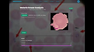 Building a Malaria Detection AI From Scratch in Rust | Real-World Impact for Africa