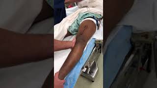 Knee Exam Under Anaesthesia (EUA) - isolated LCL injury