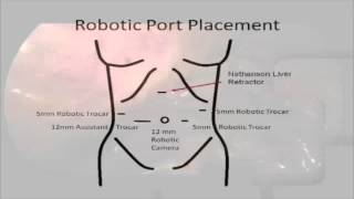 Hybrid Laparoscopic-Robotic Management of Type IVa Choledochal Cyst