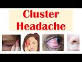 Cluster Headaches | Risk Factors, Triggers, Signs & Symptoms, Diagnosis, Treatment