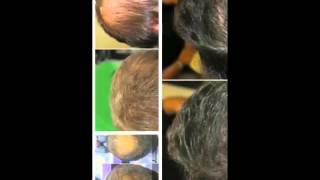 טיפולי השיער המתקדמים של הייר סנטר