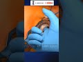 hernia surgery 3d animation shorts