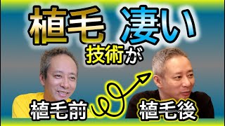 【ハゲても植毛でやり直せる】いしだ壱成さんの植毛の仕上がりが素晴らしい！植毛技術の進化が凄い【ドクターA切り抜き】いしだ壱成×麻生院長