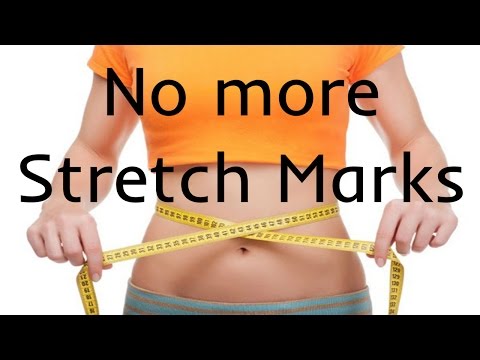 LOSE WEIGHT WITHOUT STRETCH MARKS LOSE WEIGHT WITHOUT STRETCH MARKS