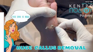 Huge Callus Removal #kentropodiou #callus #κεντροποδιου #footcare #podologos #podiatrist  #podiatry