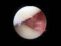 arthroscopic centralization using knotless anchors for extruded medial meniscus