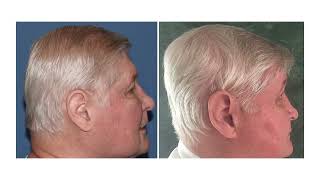 Gary's Story with Dr. Eppley - Skull Reshaping