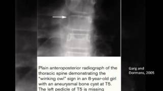 Benign Bone Lesions by Dr Jack Pang