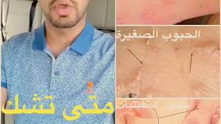 متى تشك بأنك مصاب بالجرب ⁦⚠️⁩| تعرف على أعراض وعلامات مرض الجرب Scabies