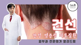 건선 피부 때문에 매일 힘들어요... / 어떻게 치료할 수 있나요? / 연세에이앤비피부과 이해진원장