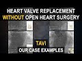 TAVI/TAVR (Heart Valve Replacement without Open Heart Surgery) | Case Examples