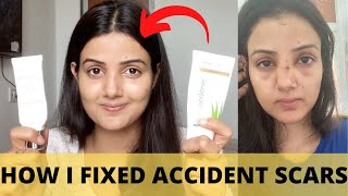 HOW I FIXED MY ACCIDENT SCARS || JUST IN 1 MONTH ||  these two creams gave me my face back....