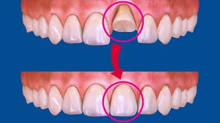 Broken Tooth Reconstruction