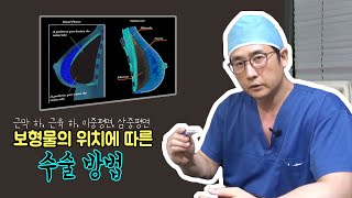 가슴성형 이중평면, 삼중평면, 근육하, 근막하 수술 방법은?