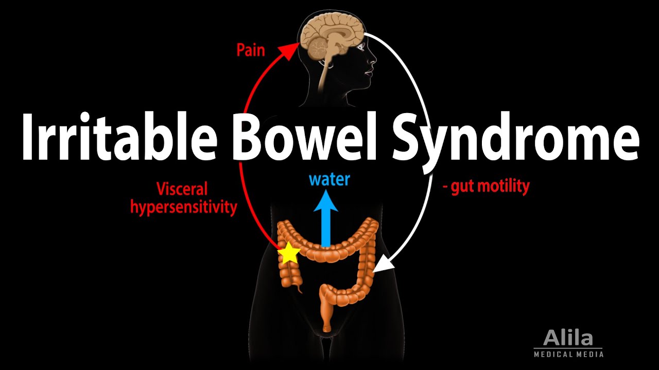 Irritable Bowel Syndrome Causes Symptoms And Treatment Irritable Bowel Syndrome Causes Symptoms And Treatment