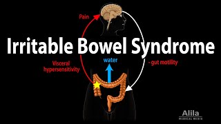 Irritable Bowel Syndrome: Pathophysiology, Symptoms, Causes, Diagnosis and Treatment, Animation