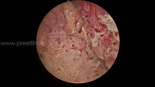 TFL Enbloc Resection of Bladder Tumour
