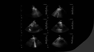 〚Ultrasound〛B-lines vs Comet tails