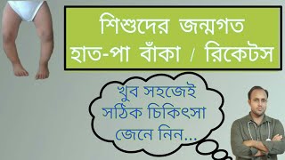 রিকেটস কি? শিশুদের হাড় বাঁকা রোগের ফিজিওথেরাপি চিকিৎসা.