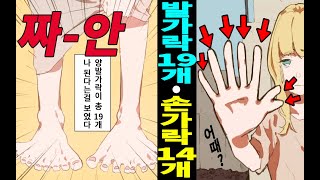 [실화]손가락 14개, 발가락은 19개?? 손가락이 많아 마녀로 몰린 여자