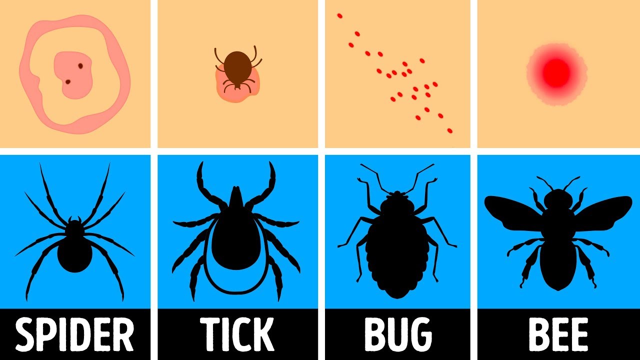 How To Identify A Bug Bite And What To Do With It Youtube How To Identify A Bug Bite And What To Do With It Youtube