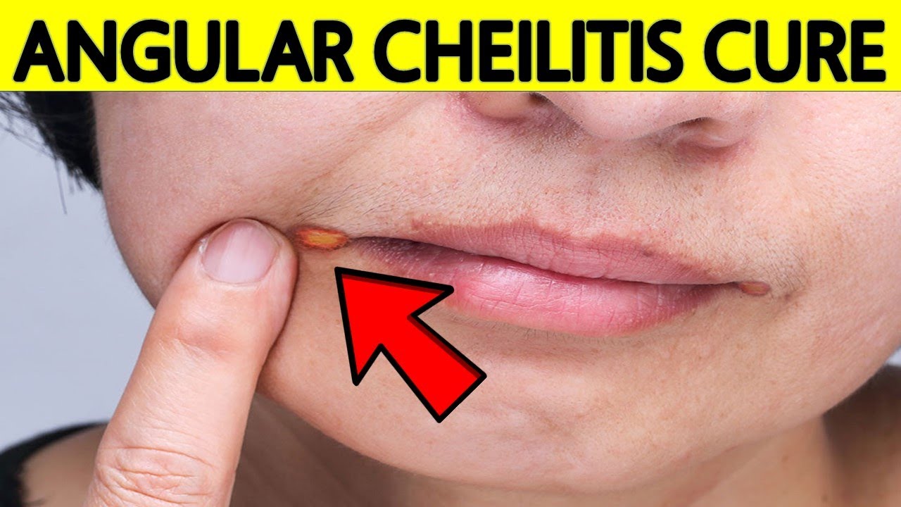 How To Get Rid Of Angular Cheilitis At Home Naturally & FAST - YouTube