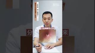 #火疖子 发红肿胀，膜上去特别痛，别挤可以这样处理#皮肤 #健康