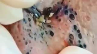 Special Super Blackheads @13