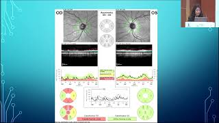 AIOCMT3 2024   GP21 topic   Dr Soumya P P Decoding RNFL OCT in Glaucoma   a practical version