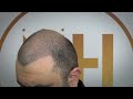 ESTHETIC HAIR TURKEY - 10TH DAY WASHING VIDEO