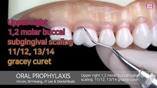 Upper right 1,2 molar buccal-subgingival scaling (11/12, 13/14 gracey curet)