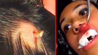 Huge Larva Pulled Out Of Lady's Scalp and Lip