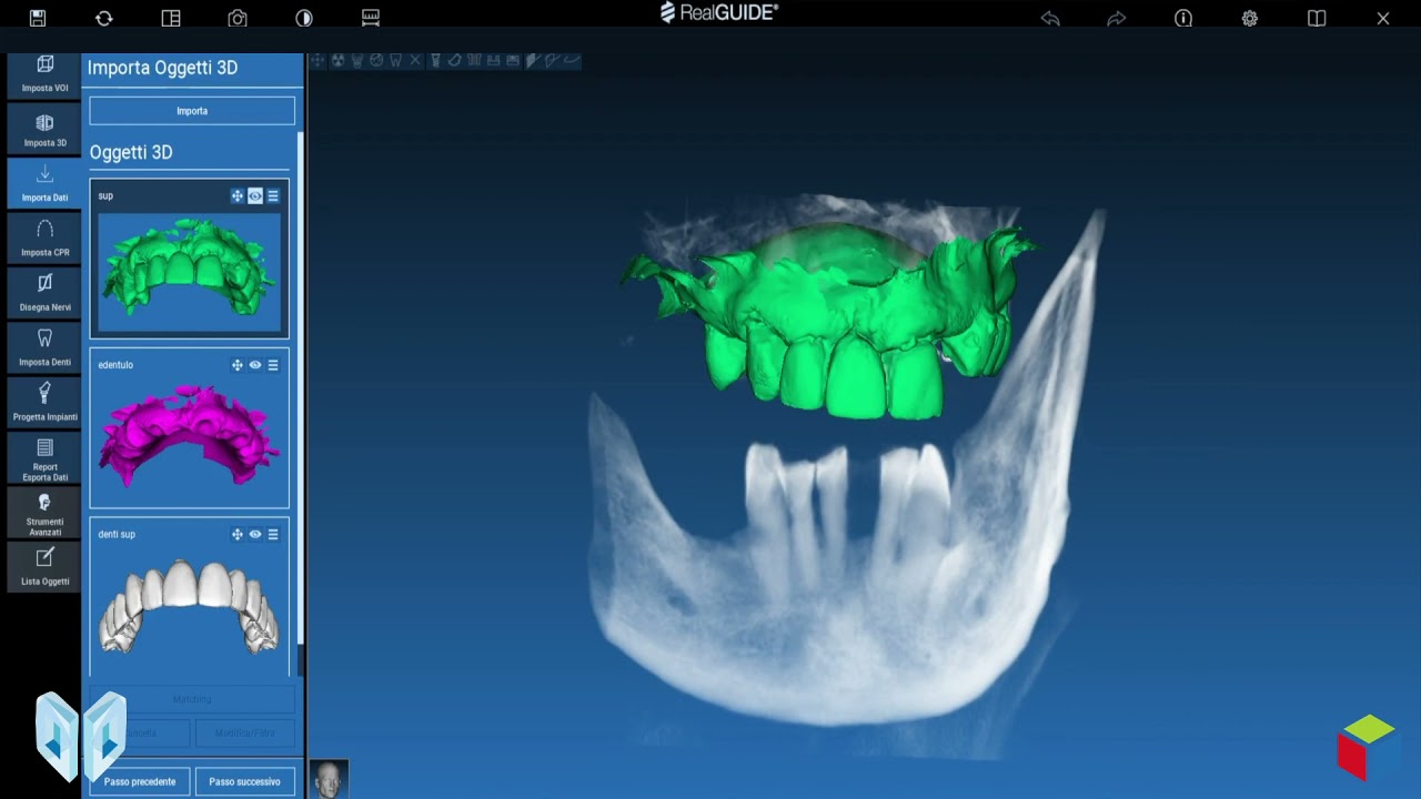 Progettazione Implantare Di Chirurgia Guidata Doppio Carico Immediato ...