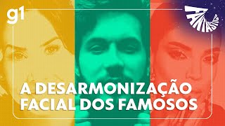 Celebridades buscam ajuda para reverter efeitos da harmonização facial