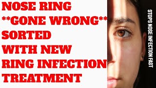 NOSE RING **GONE WRONG** SORTED WITH NEW TREATMENT!