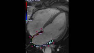 Afib Catheter Ablation Biomarker – Four Chamber View