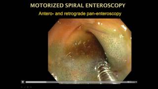 Motorized Spiral Enteroscopy