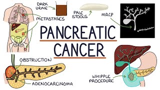 Understanding Pancreatic Cancer