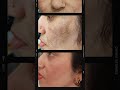 melasma is treatable with the skincare howtogetridofdarkspots dermatologistapproved