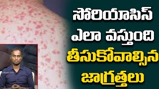 సోరియాసిస్ ఎలా వస్తుంది.. | Psoriyas Disease Treatment Telugu | Dr.Bharadwaj about Psoriyas | LH