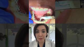 How Does Lingual Braces Look Like?!