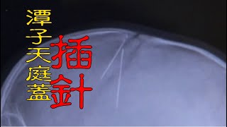 【#老Z調查線 182預告】忤惡!惡伯母爭寵竟朝姪子天庭蓋插針...還餵姪女白藥水奶粉 @台灣大搜索CtiCSI