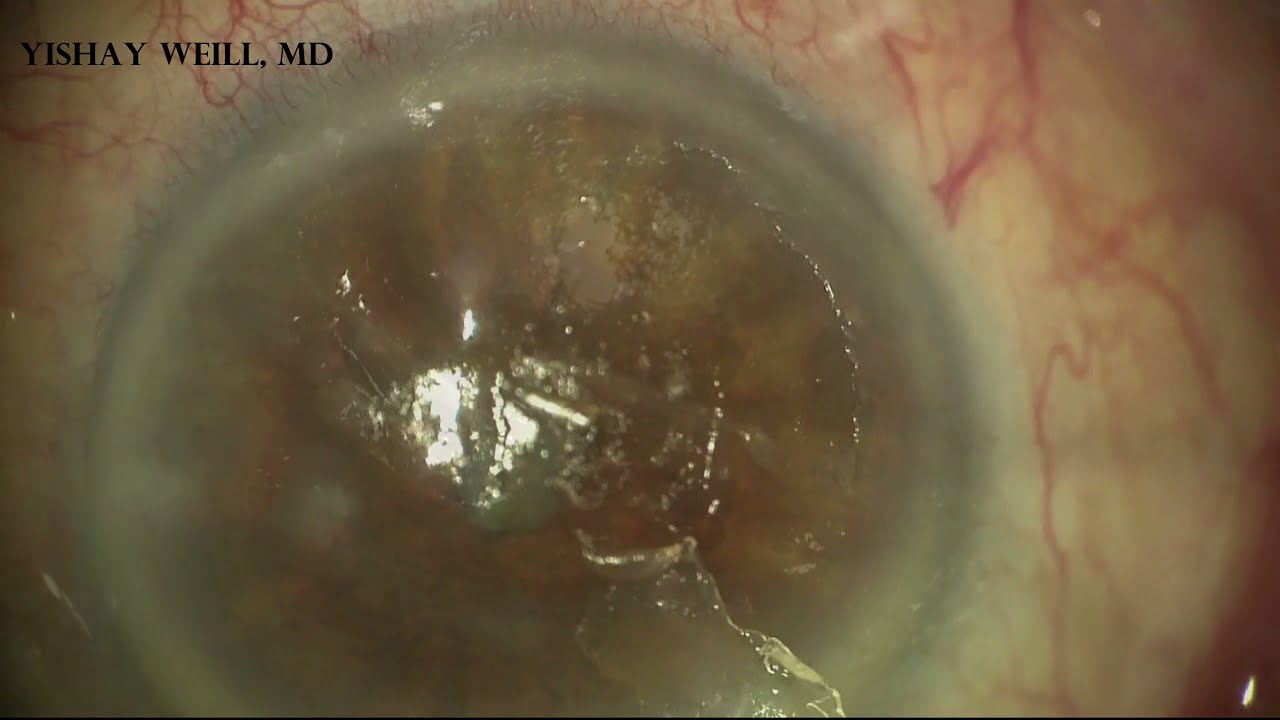 Superficial Keratectomy + MMC 0.02% For Salzmann's Nodule (High Quality ...