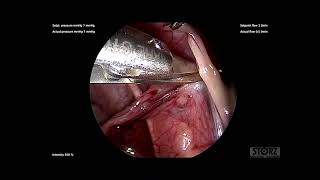 Laparoscopic Ovarian Tissue Harvesting for Cryopreservation from a Child with Galactosemia